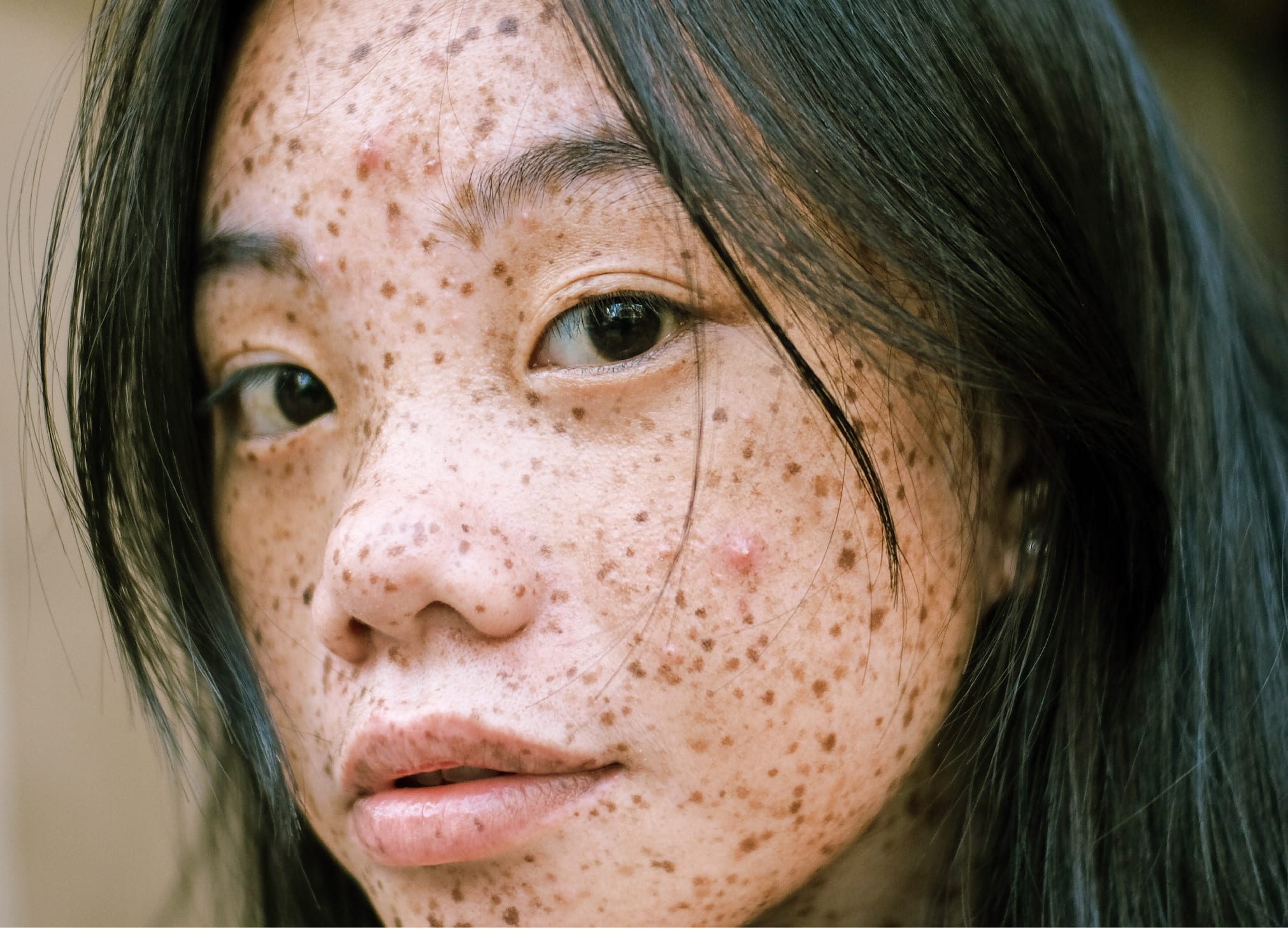 Period acne: Why you get it & what to do about it