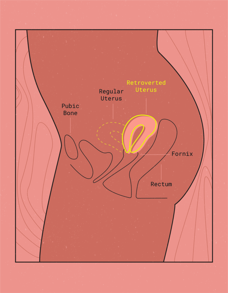 retroverted uterus diagram