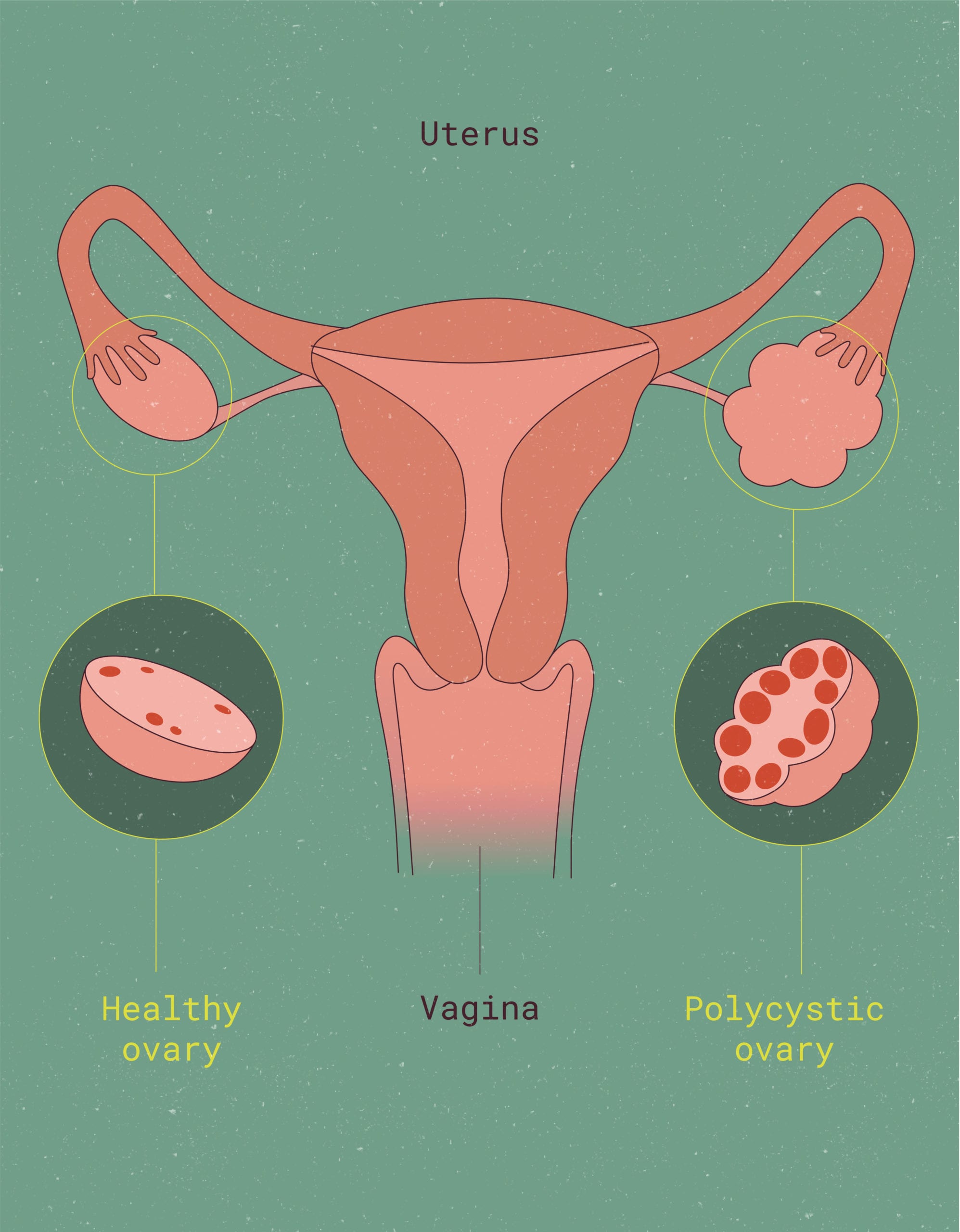 The Flex guide to polycystic ovary syndrome (PCOS)
