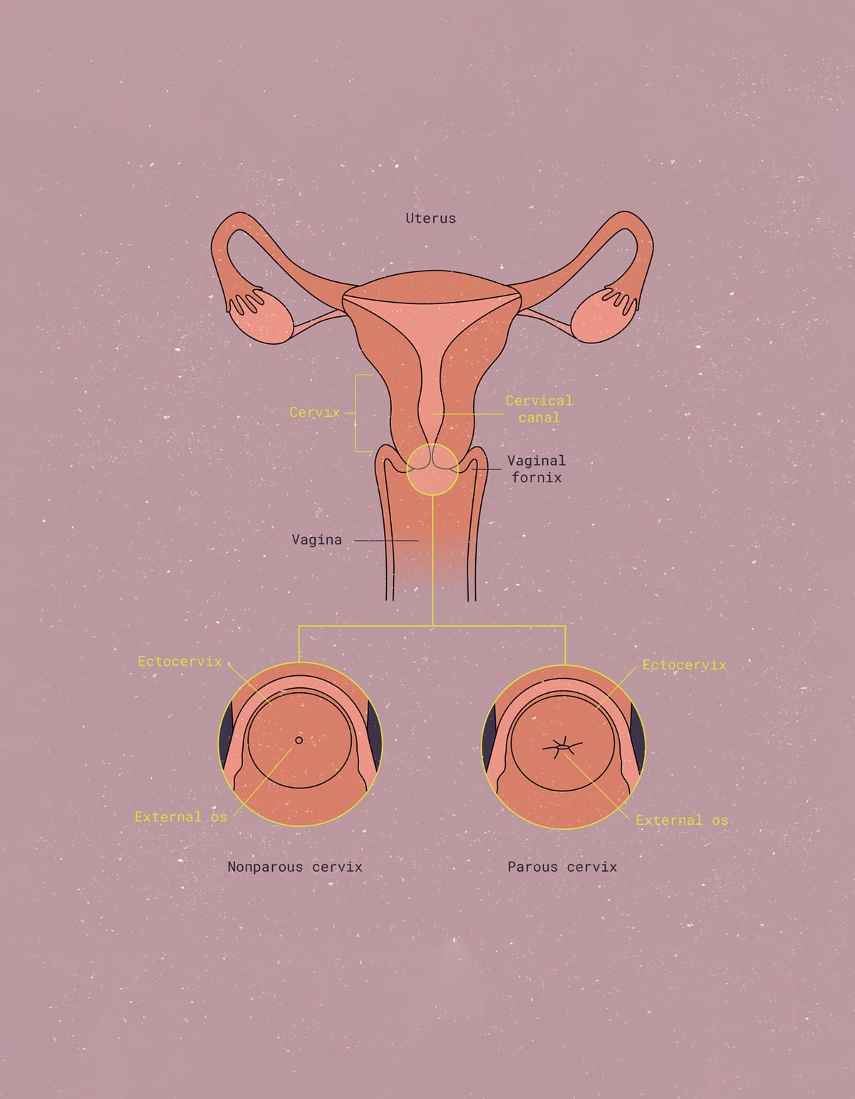 Cervix penetrating
