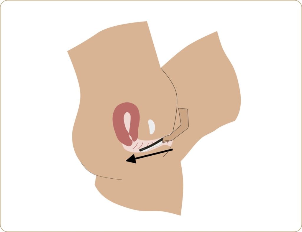 how to insert flex disc