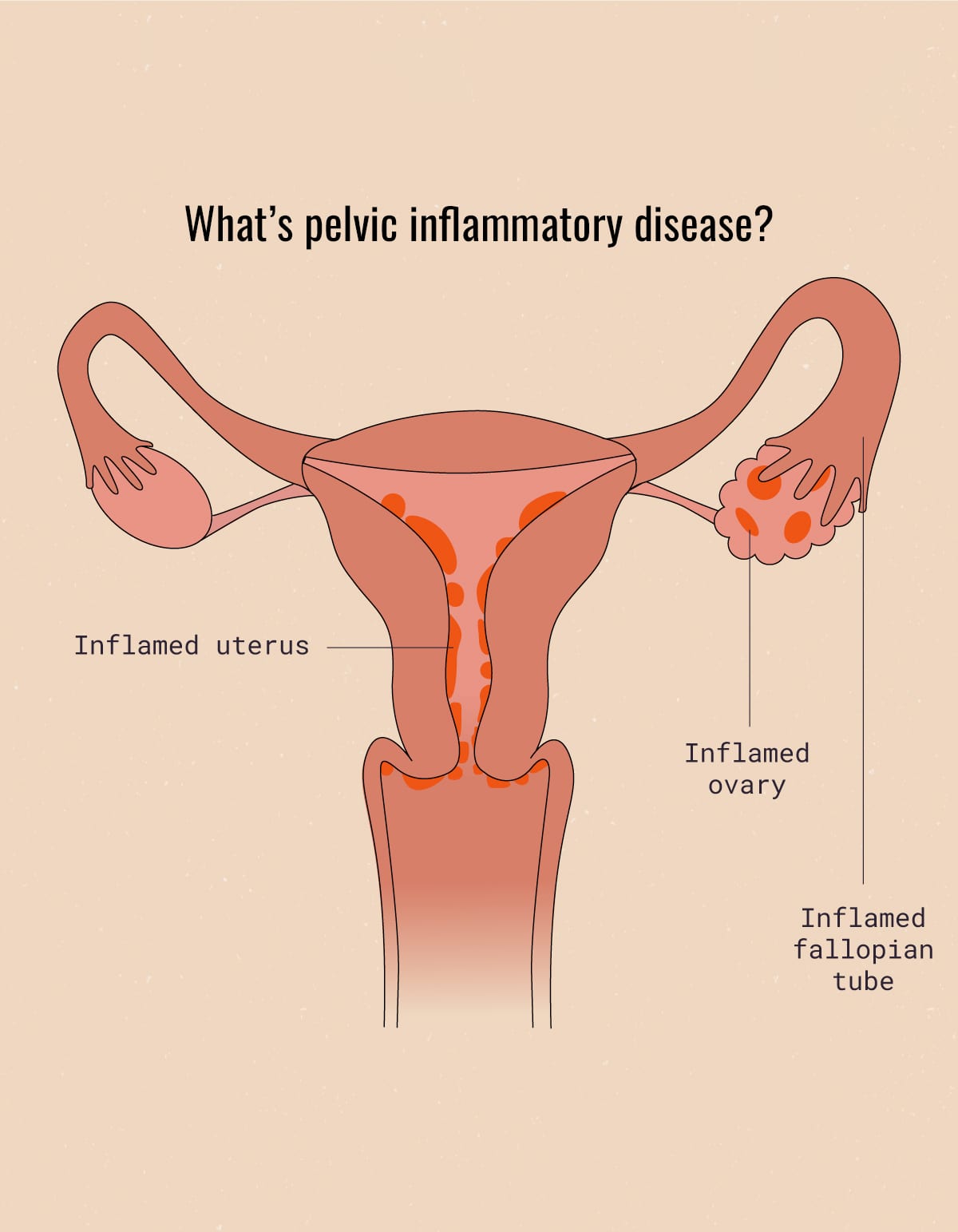 What is Pelvic Inflammatory Disease (PID)? Causes, symptoms, & treatment
